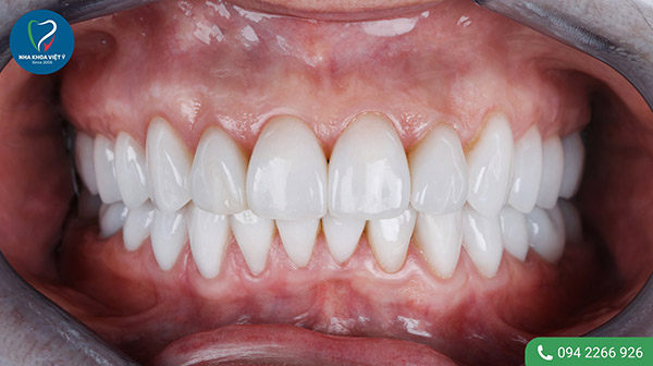 Làm thế nào để khắc phục răng trám ố vàng?