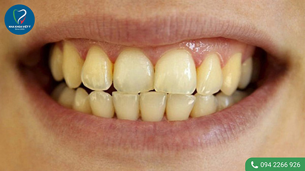 Những trường hợp răng vàng bẩm sinh