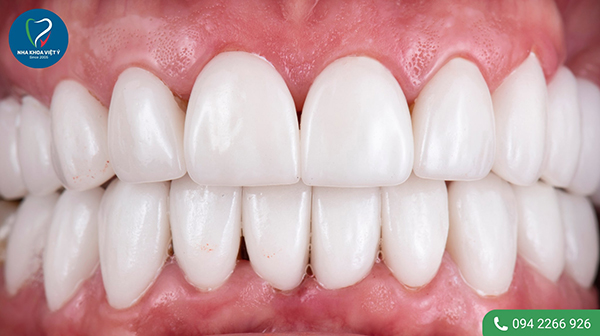 Ưu và nhược điểm của việc bọc răng sứ cho răng thưa