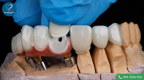 Nên thực hiện bọc răng sứ hàm dưới bao nhiêu răng?