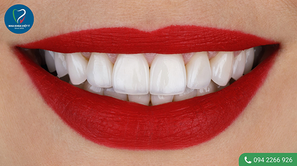 Bọc răng sứ kim loại có tốt không? 