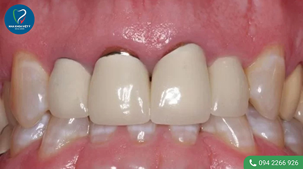 Dấu hiệu nhận biết bọc răng sứ phần chân răng bị hở