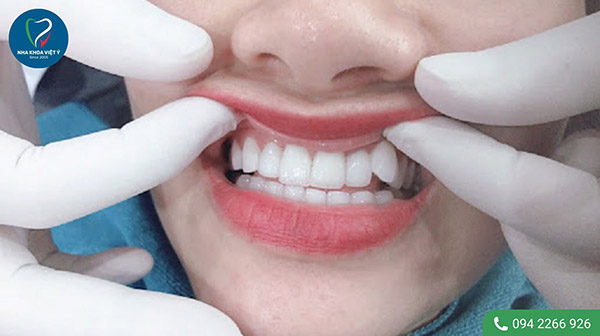 Ưu điểm của phương pháp bọc sứ răng khểnh