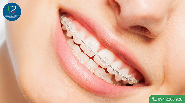 Niềng răng ở độ tuổi 25 cần lưu ý những gì?
