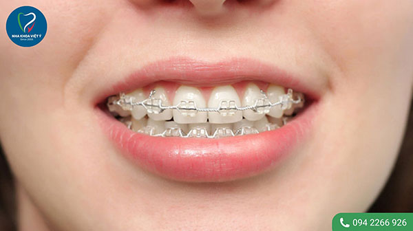 30 tuổi nên niềng răng bằng phương pháp nào phù hợp?