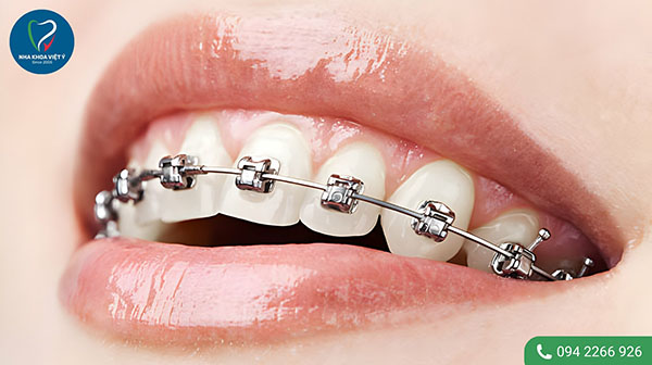 30 tuổi niềng răng mất bao lâu thì tháo niềng?