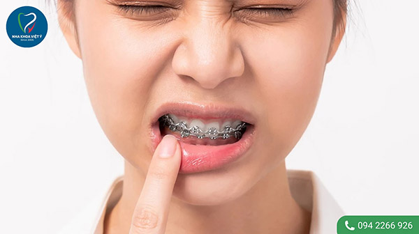 Tại sao xuất hiện sự đau nhức khi niềng răng?