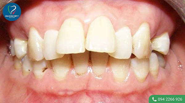Các nguyên nhân dẫn đến tình trạng răng bị hô