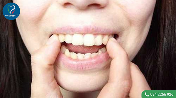 4 cách chữa răng hô nhẹ không cần niềng
