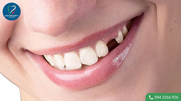 Mất răng và những nguyên nhân gây ra
