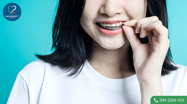 4 mẹo hữu ích giúp rút ngắn thời gian niềng răng 