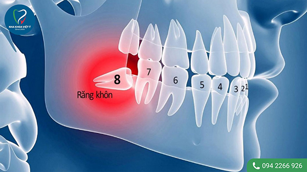 Các răng thường được chỉ định nhổ khi niềng răng