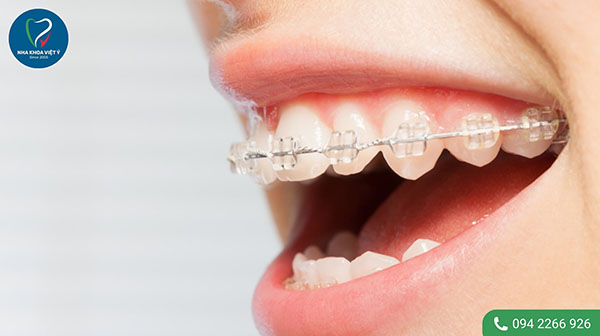Những phương pháp niềng răng khớp cắn sâu hiệu quả