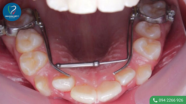 Các trường hợp cần nong hàm khi niềng răng