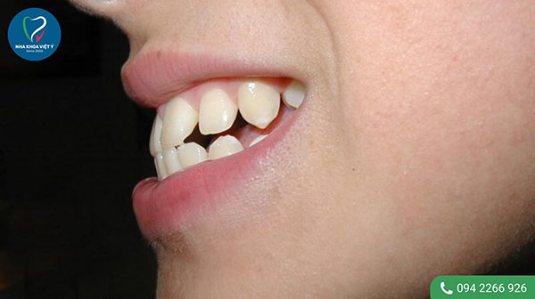 Dấu hiệu nhận biết răng hô nhẹ 