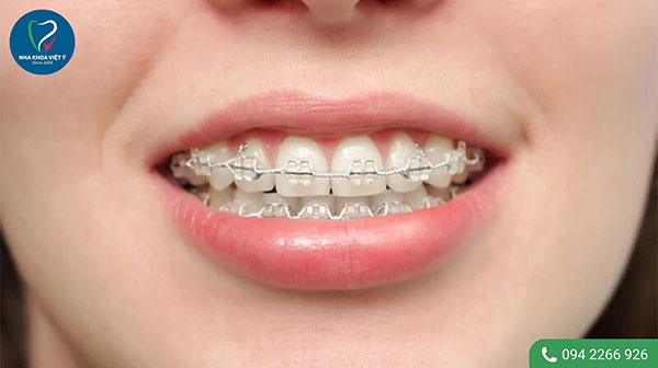 Quy trình niềng răng hô nhẹ như thế nào?