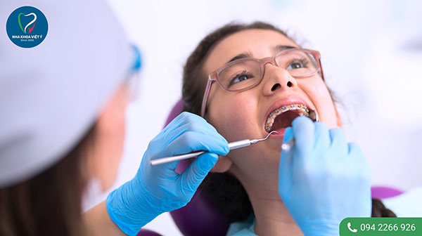 Làm thế nào để tránh sâu răng khi đang trong quá trình niềng răng?