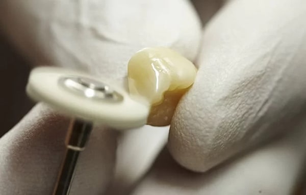 Vậy bọc răng sứ mất bao lâu?