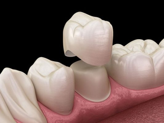 Nên bọc răng sứ loại nào tốt nhất? Các loại răng sứ phổ biến
