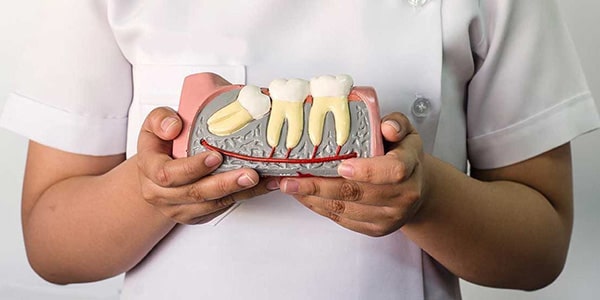 Khi nào nên nhổ răng khôn mọc ngầm?