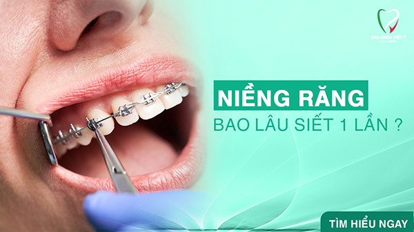 Niềng răng bao lâu siết một lần? Những cách giảm đau sau khi thực hiện siết răng