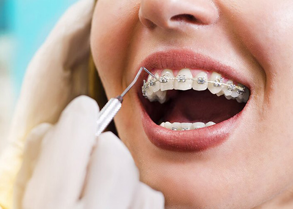 Mục đích niềng răng thẩm mỹ là gì?