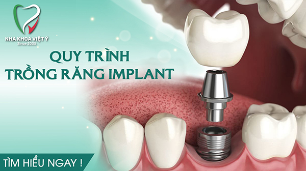 Quy trình trồng răng Implant tiêu chuẩn mà bạn nên biết