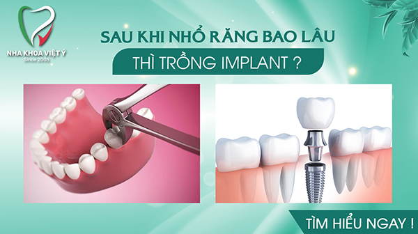 Sau khi nhổ răng bao lâu thì trồng Implant là tốt nhất?