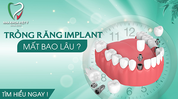 Trồng răng Implant mất bao lâu? Quy trình trồng răng Implant